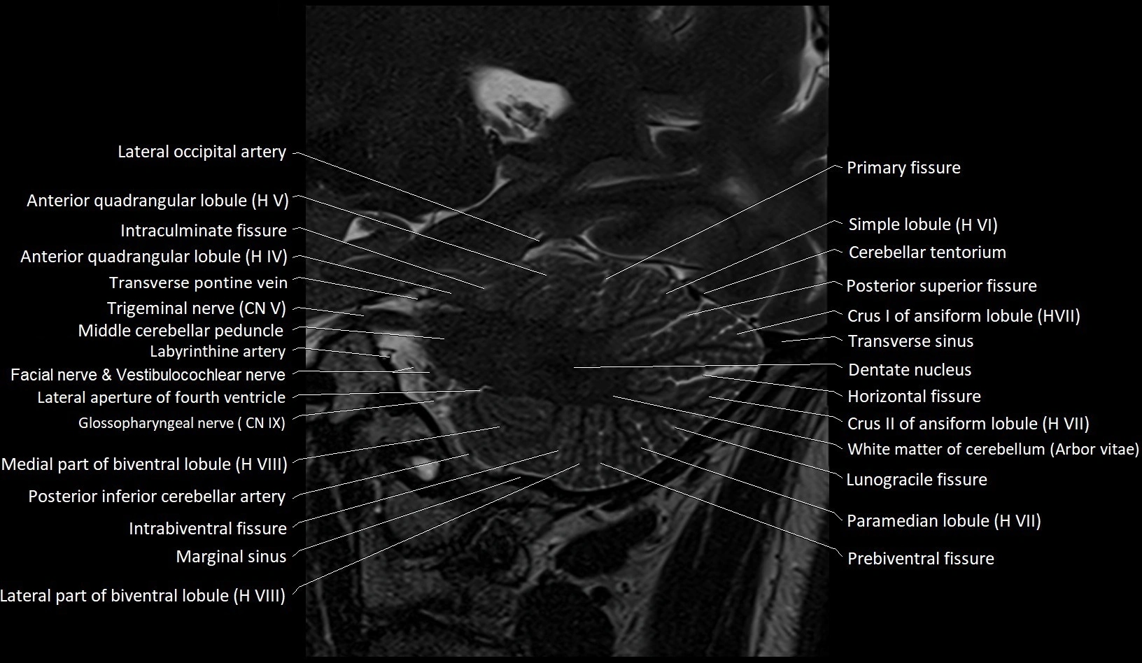 MRI Cerebellar anatomy sagittal High-resolution labelled image 20.webp